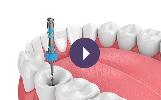 Click to start the Endodontic Presentation